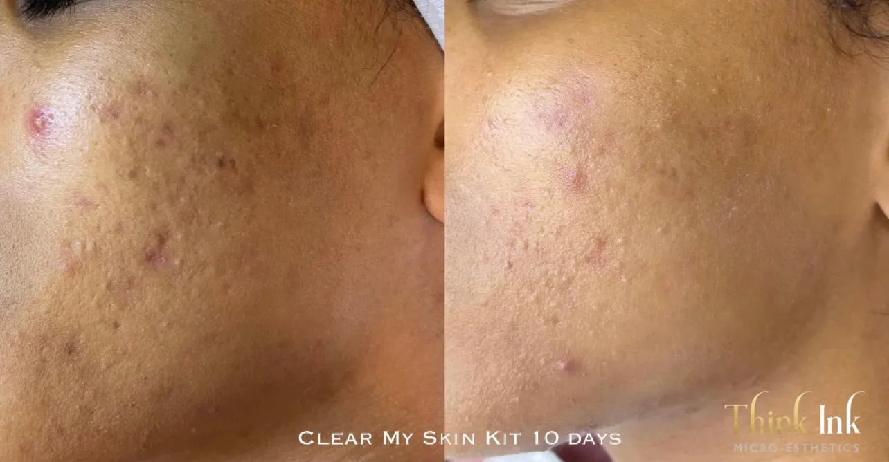 Clear My Skin Kit
