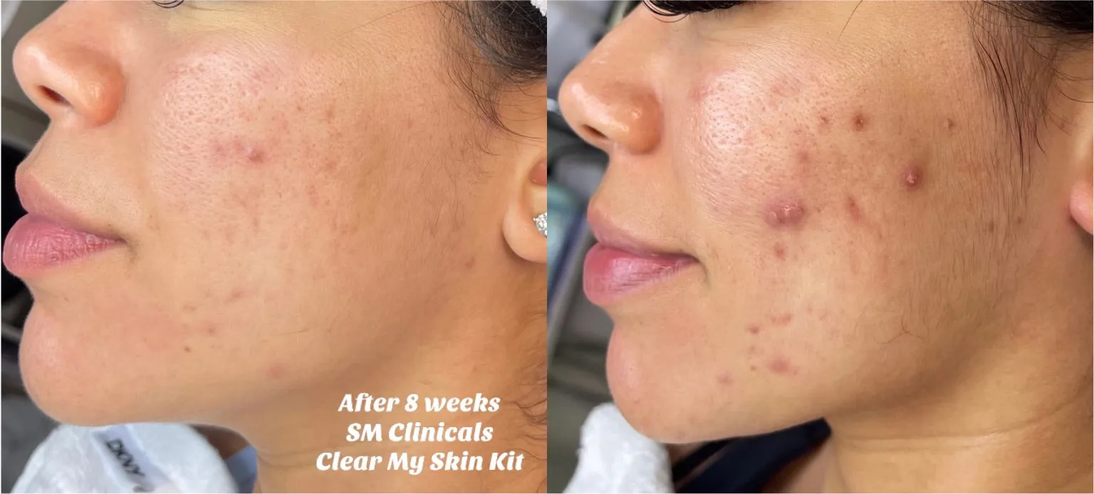 Clear My Skin Kit